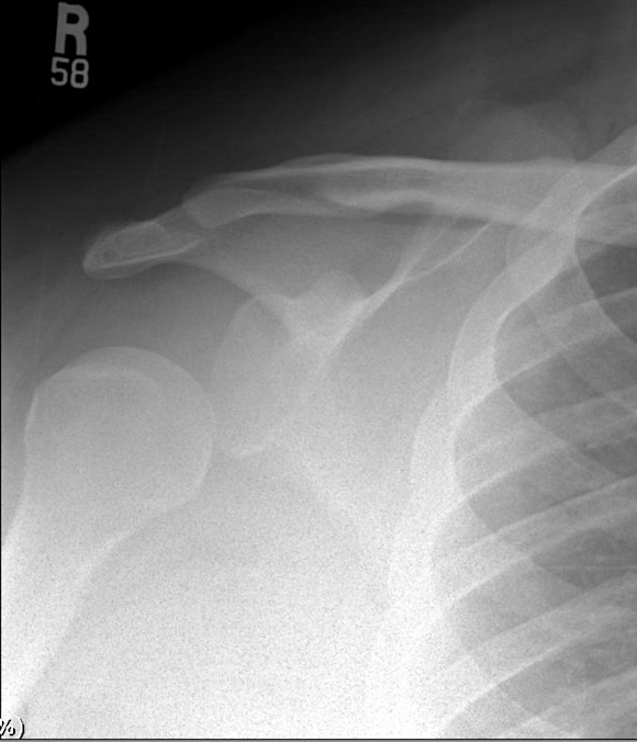 AP view of the right shoulder