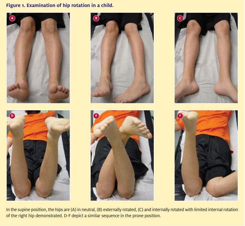  Examination of hip rotation in a child.