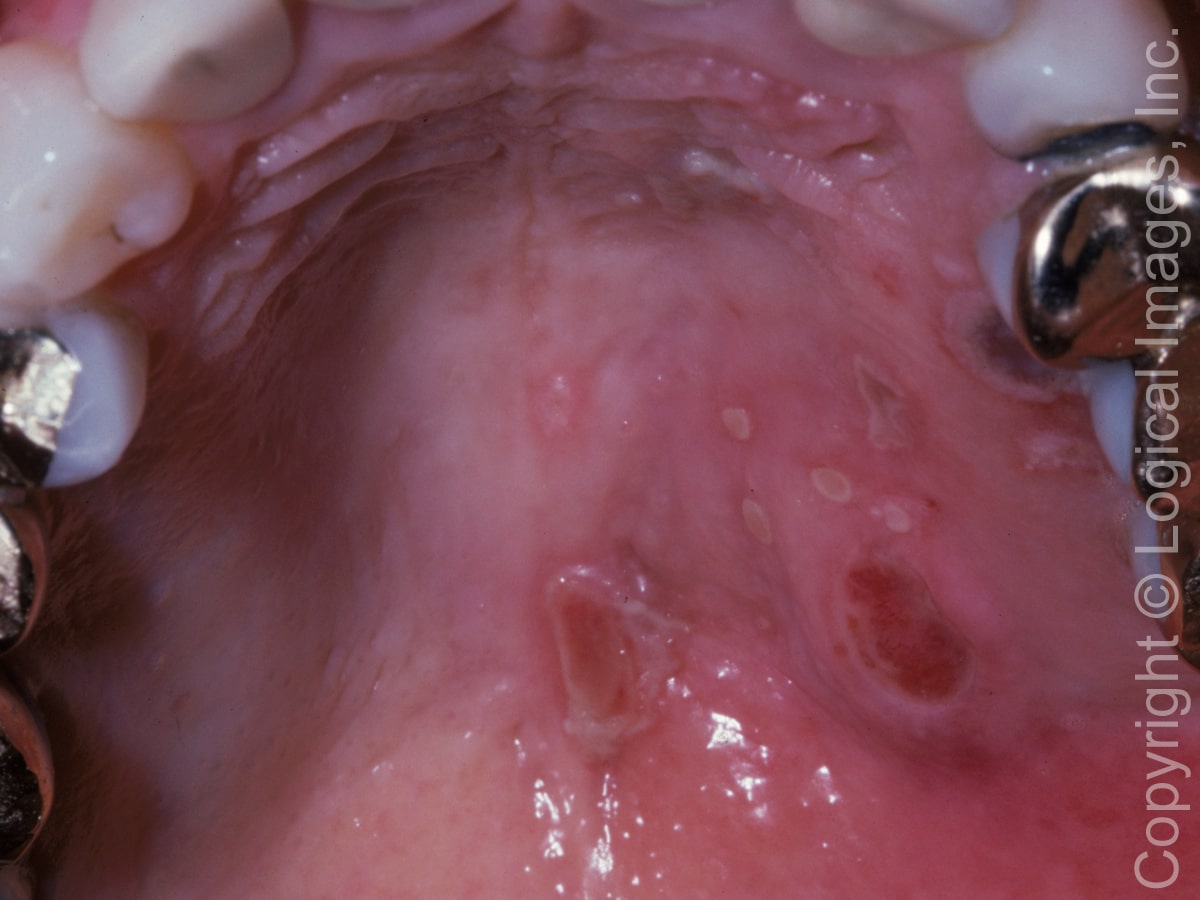 76 Year Old Woman With Sudden Ulcers On Roof Of Mouth Page 2 Of 2