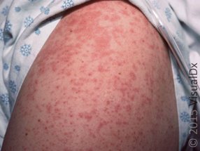 Measles Adult 55