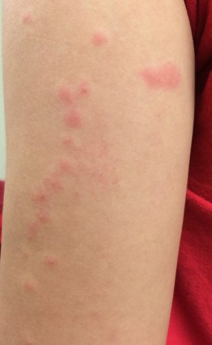 ... bed bug bites the rash has the characteristic bites in a row pattern