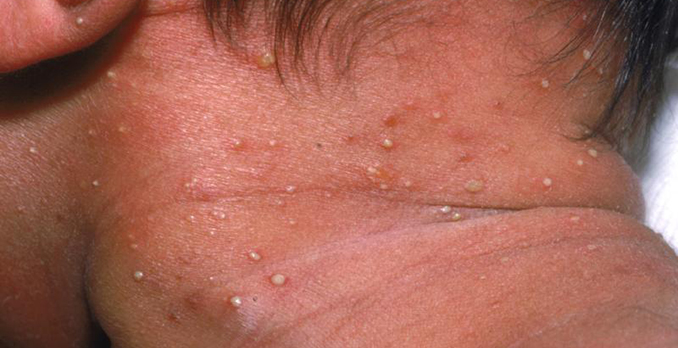 Newborn Red Pimples On Face And Neck