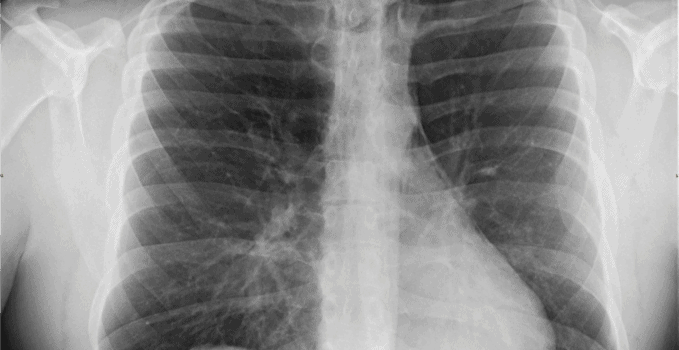 A 35-Year-Old Man with Chest Pain