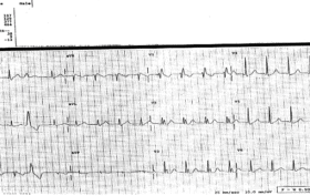 A 60-Year-Old Man with a 2-Year History of Dizziness