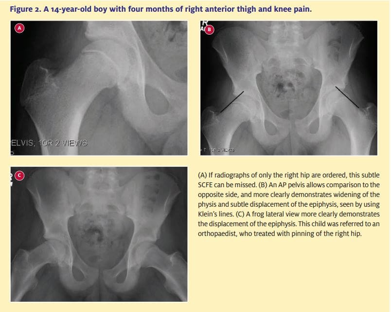  A 14-year-old boy with four months of right anterior thigh and knee pain.