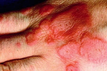 Management of Erythema Multiforme in the Urgent Care Setting