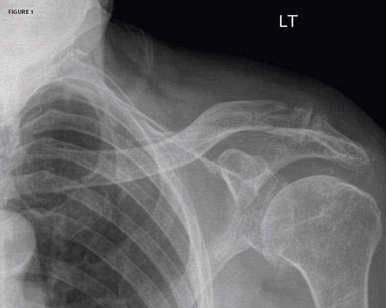 Distal Clavicle Fracture