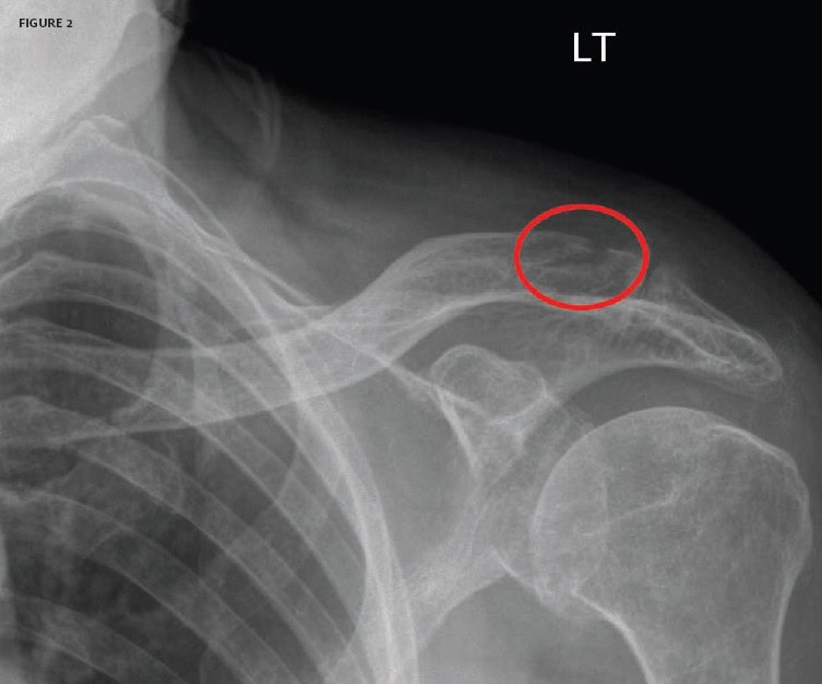 Distal Clavicle Fracture