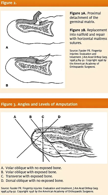 Fingertip and Nailbed Injuries