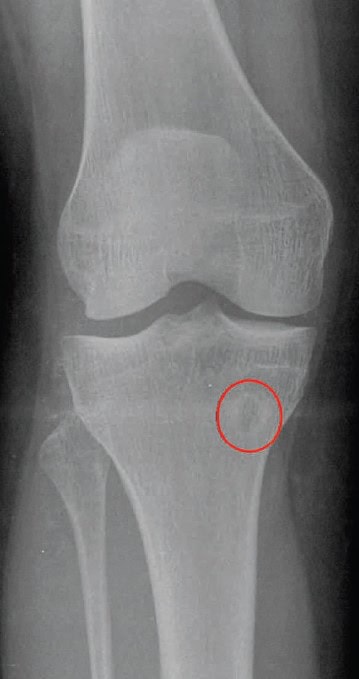 Lytic Lesion on Proximal Tibia