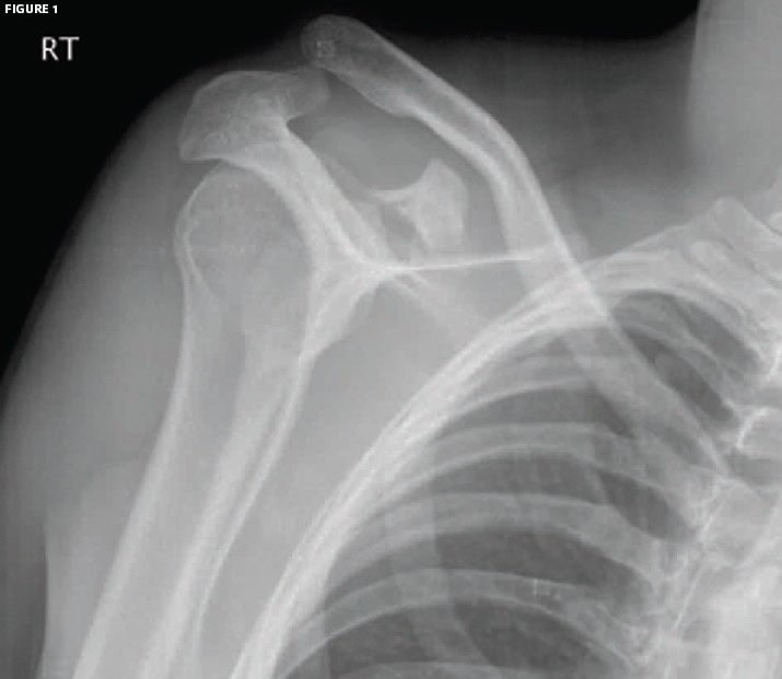 fracture of the coracoid process