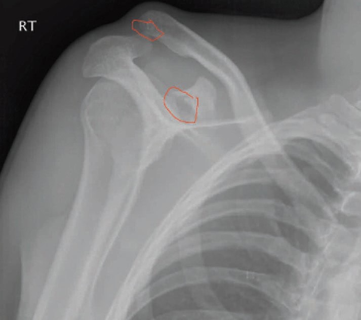 fracture of the coracoid process