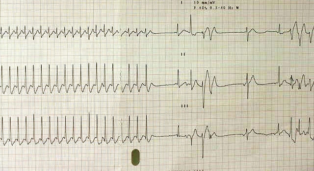 ECG Challenge: A 90-Year-Old Woman with Intermittent Lightheadedness