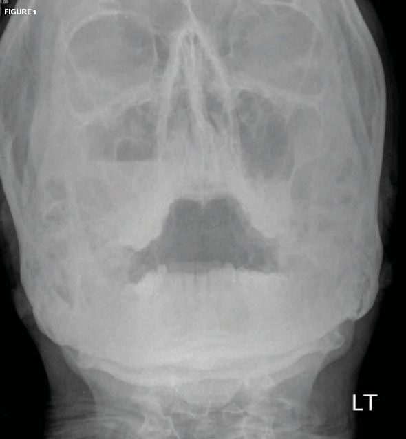 Orbital Fracture with Bleeding into Sinus 