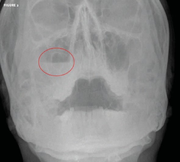 Orbital Fracture with Bleeding into Sinus 