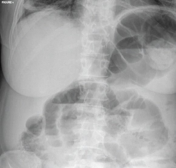 Small Bowel Obstruction and Right Lower Lung Atelectasis