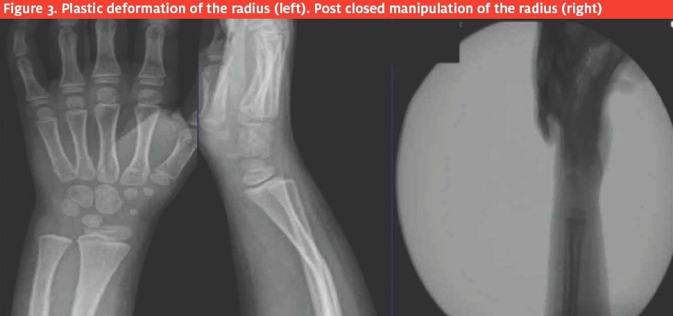 Deformation of Radius pre and post manipulation Common Pediatric Injuries