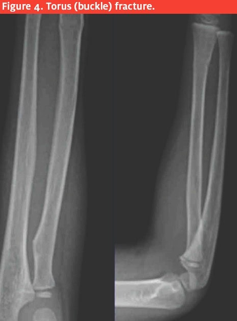 Common Pediatric Injuries - Torus (buckle) Fracture