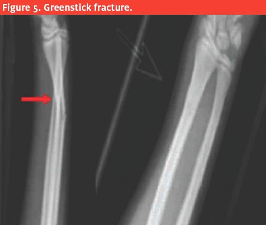 Common Pediatric Injuries - Greenstick Fracture