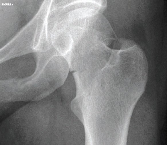 Femur Neck Fracture