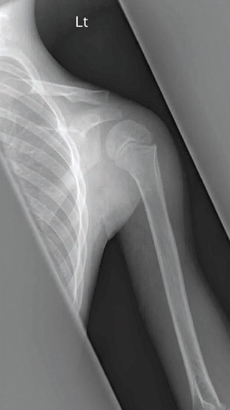 greenstick fracture of the proximal humerus