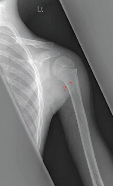 greenstick fracture of the proximal humerus