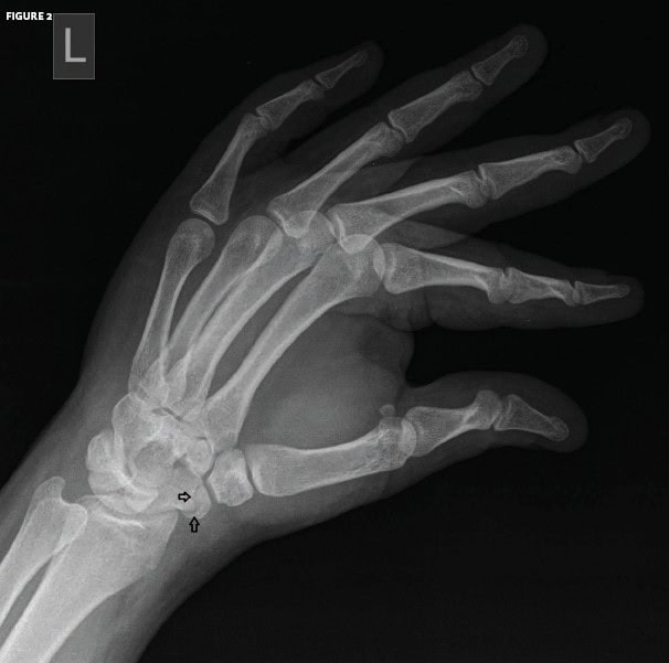 Fracture of the Scaphoid