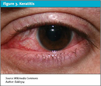 Ocular Complaints in Urgent Care