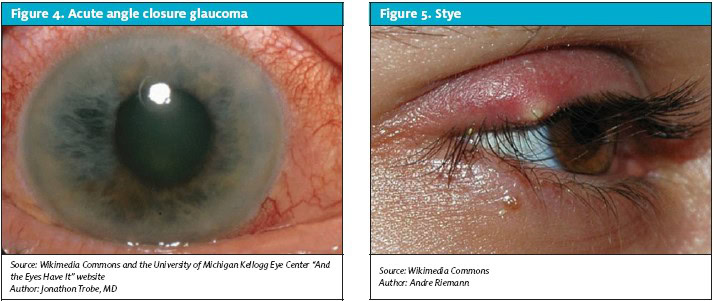 Glaucoma and Stye Images for Ocular Complaints in Urgent Care