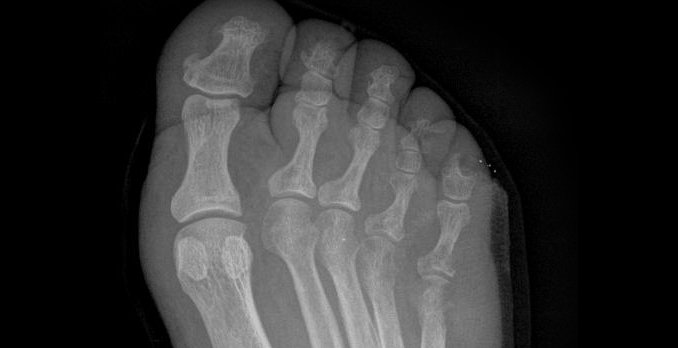 59-year-old man with diabetes presenting with pain and swelling over his lateral right foot