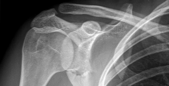 21-year-old man with a blow to his right shoulder