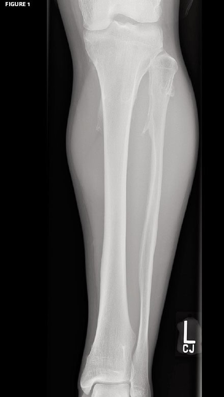 Osteochondromatosis