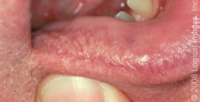 Lesions On Lips