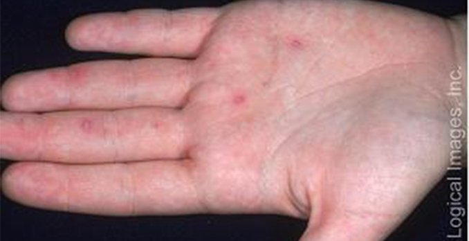 32-year old female with fever, rash and scattered vesicles ...