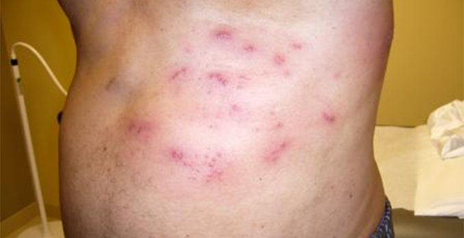 diabetic rash treatment