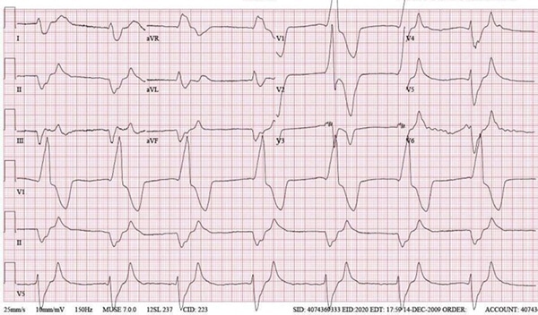 37-year-old diabetic female feeling weak after switching diuretics ...