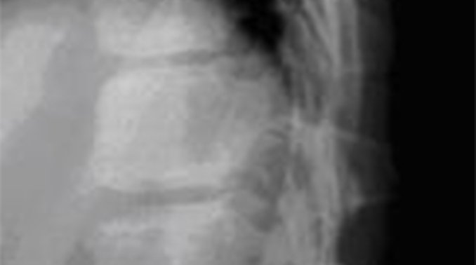 14 year old Boy With Lower Back Pain Stemming From Fall Journal Of 