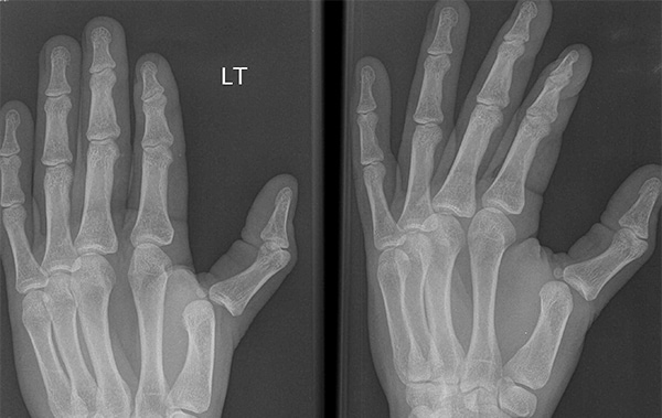 32-year Old Experiences Deforming Blow To Left Thumb - Journal Of 