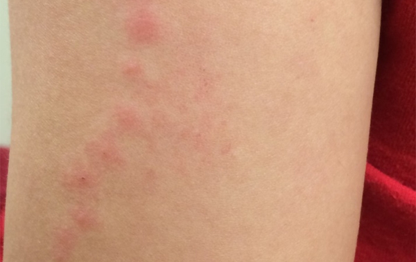 3 Dots In A Row Rash