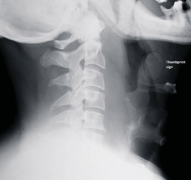 Epiglottitis X-ray