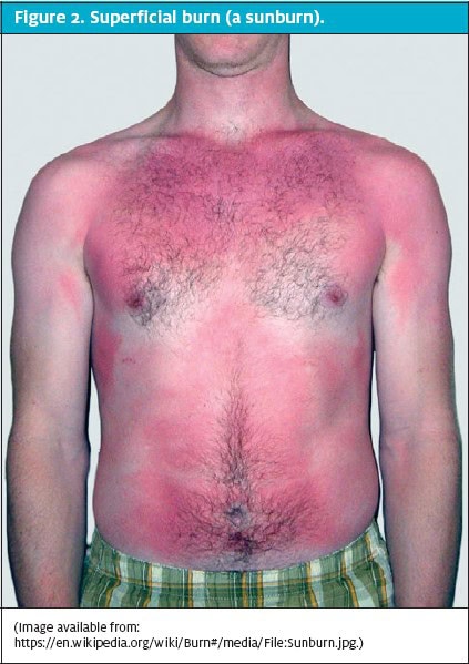 Urgent Care Burns - Sun Burn