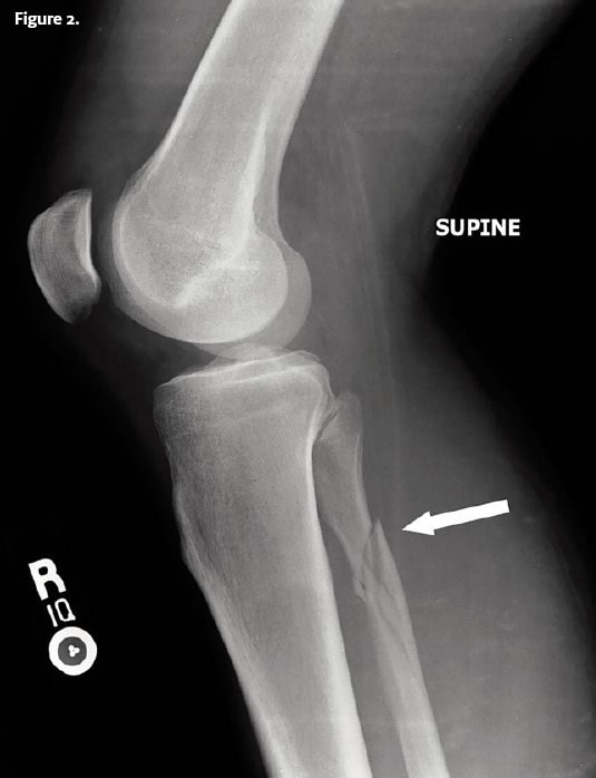 Maisonneuve Fracture