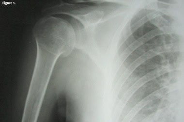 Shoulder Pain in a 62-Year-Old After a Fall