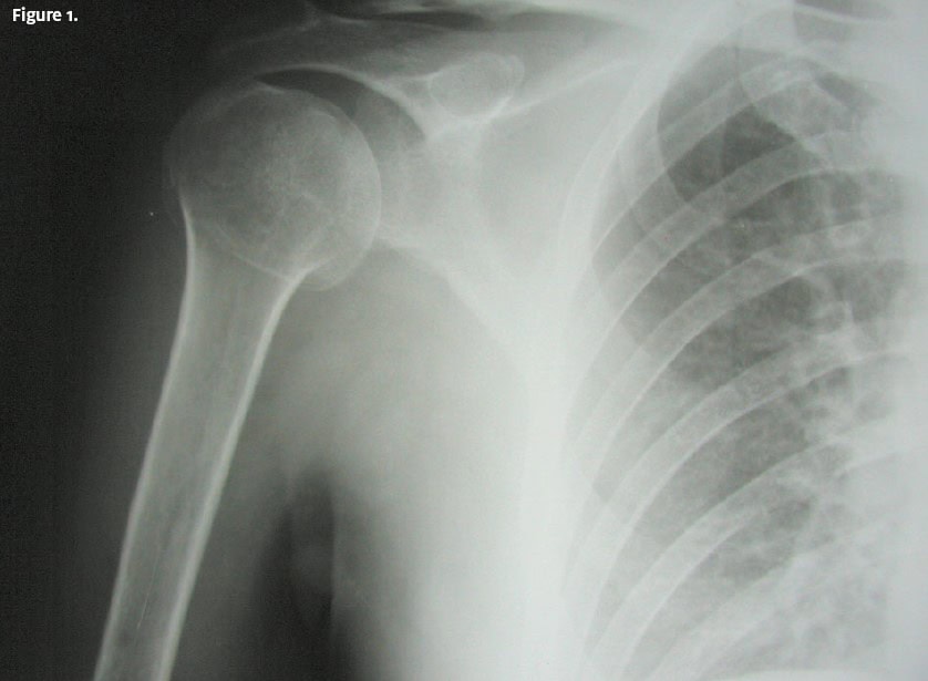 proximal humerus fracture
