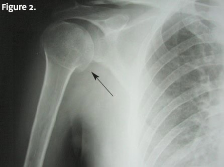 Proximal Humerus Fracture