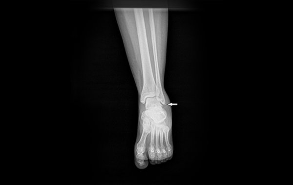lateral malleolus fracture physical therapy protocol