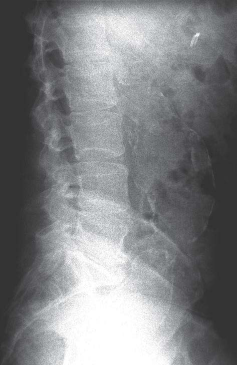 Abnormal Aortic Aneurysm