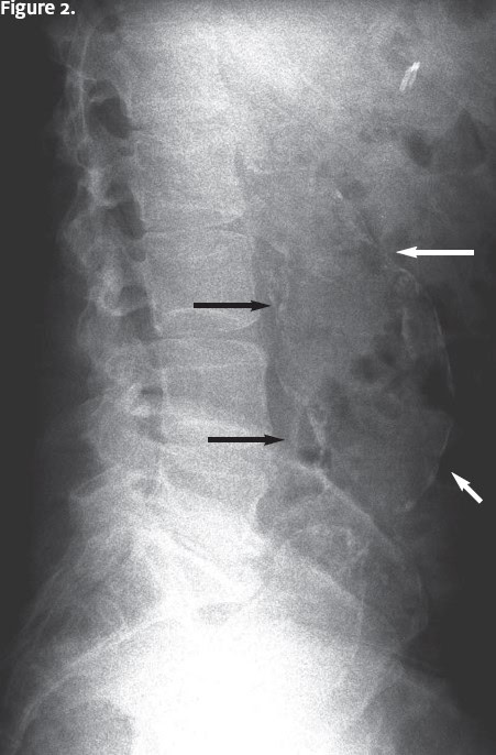 Abnormal Aortic Aneurysm x-ray 2