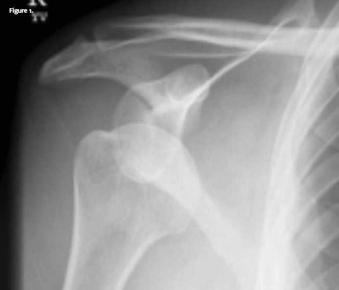 Anterior Shoulder Dislocation