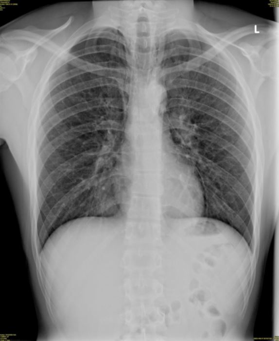 an-18-year-old-female-with-sudden-onset-chest-pain-journal-of-urgent